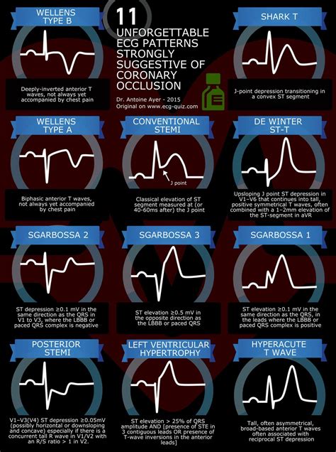 Stemi And Equivalent Ecg Quiz