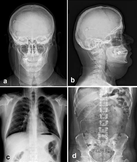 Figure Shunt Series Including Biplanar Head Statpearls Ncbi