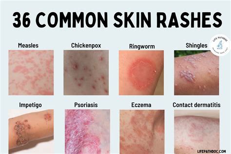 Rash 36 Common Skin Rashes Pictures Causes And Treatment