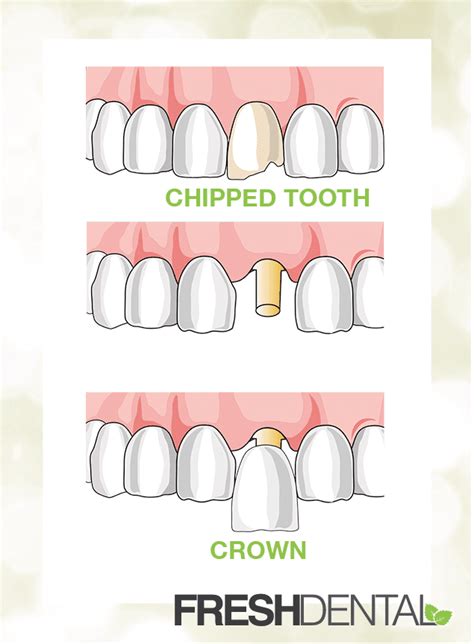 Dental Crown Procedure In Huntersville Nc Fresh Dental