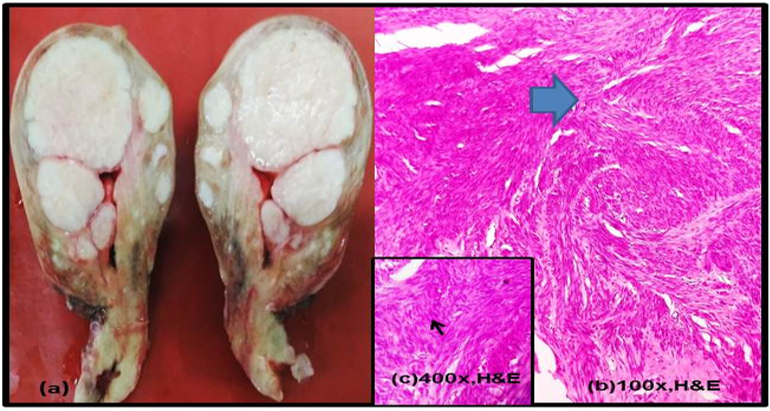 How Fibroids Are Measured