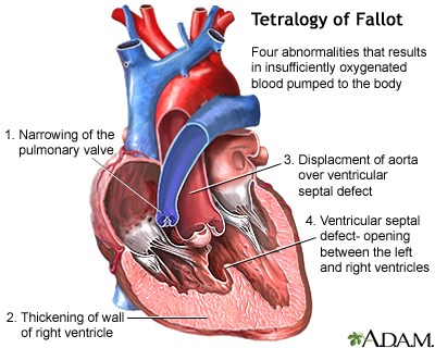 Tetralogy of Fallot | UF Health, University of Florida Health