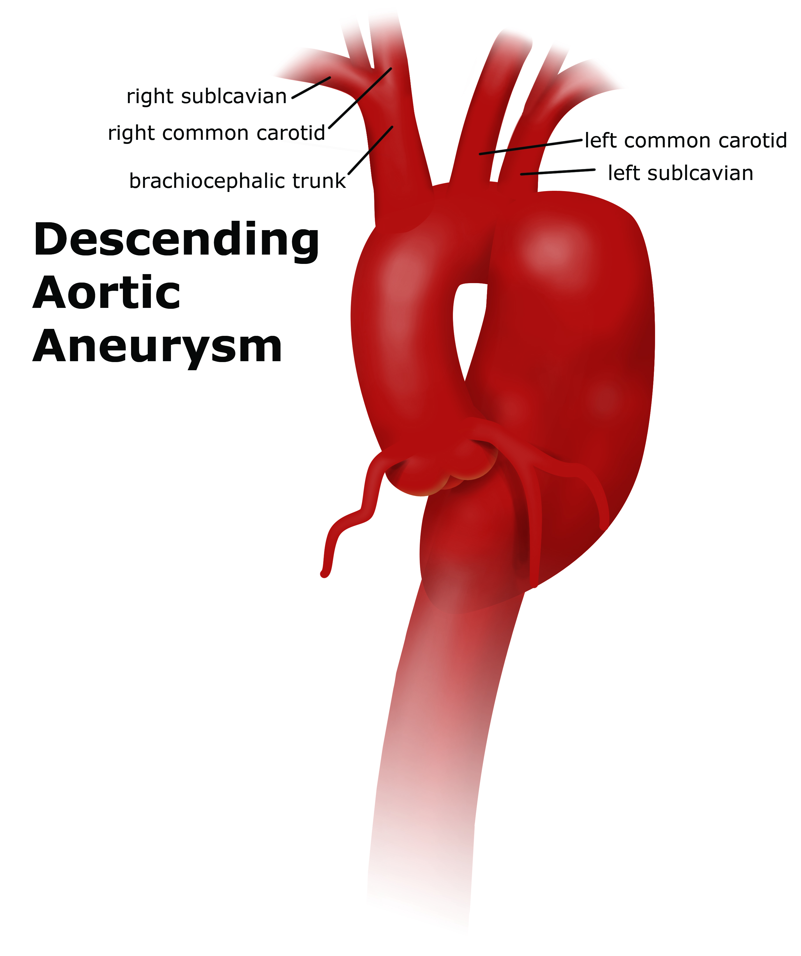 Aorta Artery Aneurysm