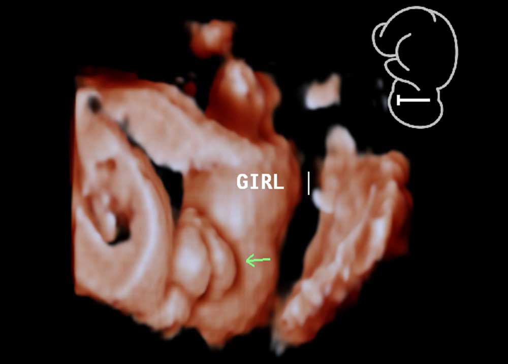 12 Week Ultrasound Girl Vs Boy