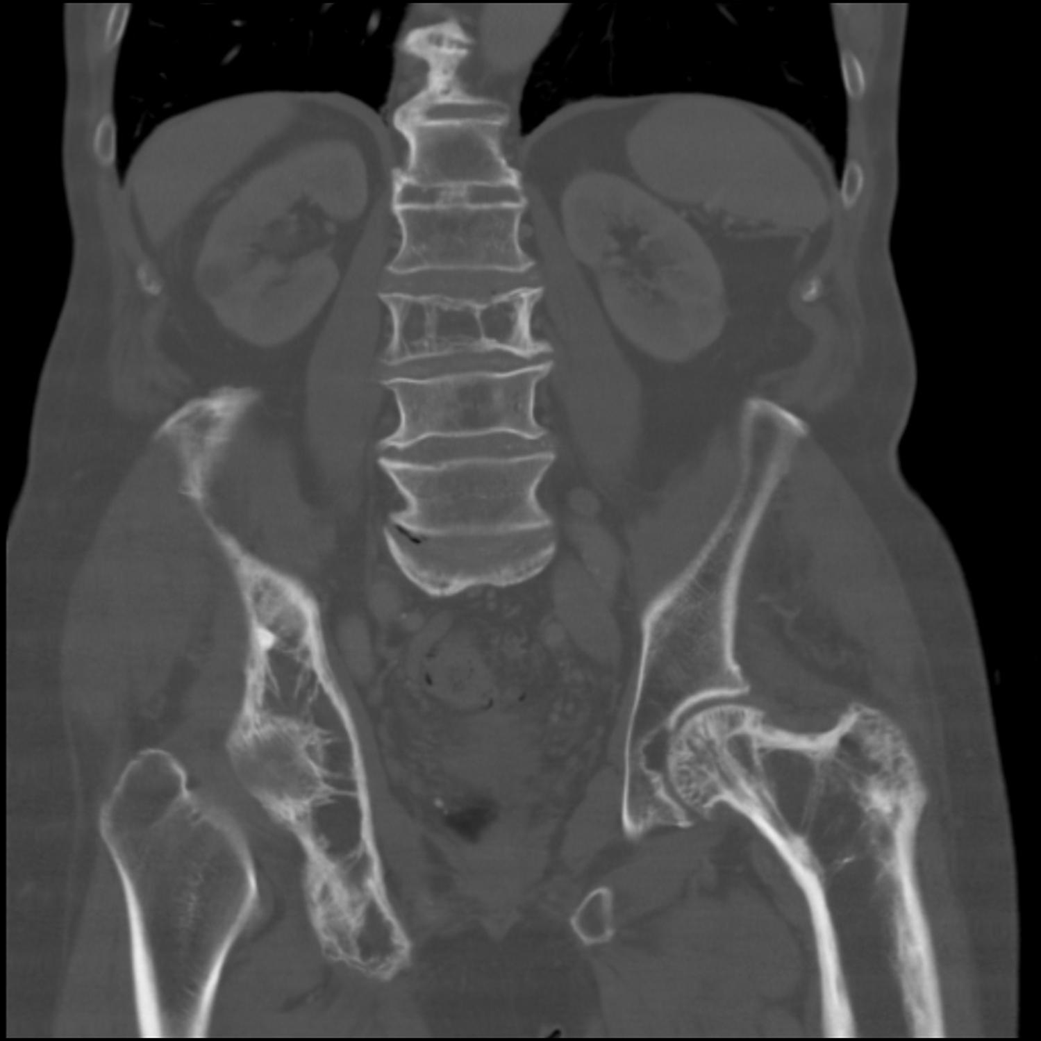 Paget Disease of Bone (Osteitis Deformans) - Orthopedics - Medbullets ...