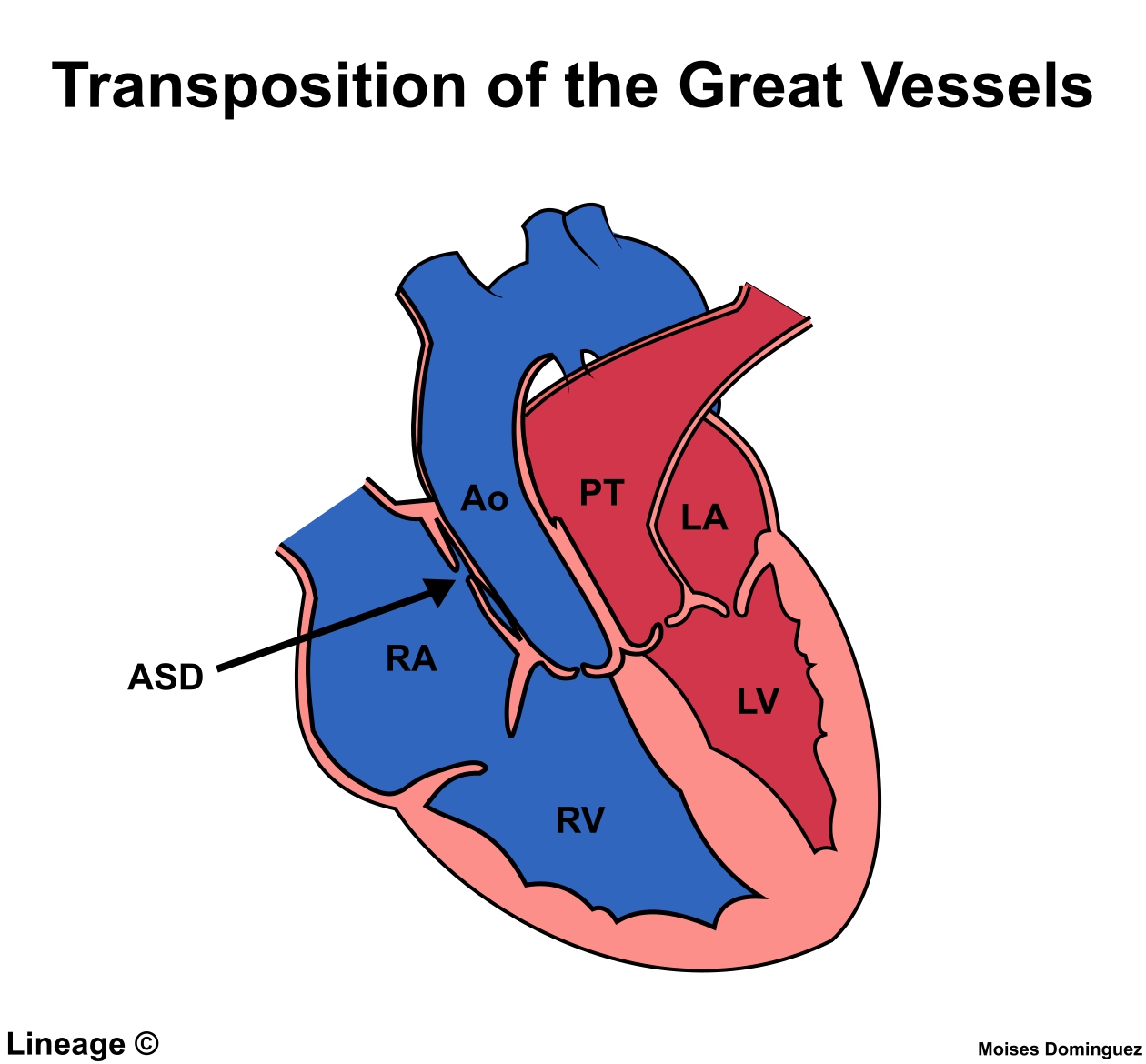 Transposition Of The Great Arteries Coronary Artery Anatomy