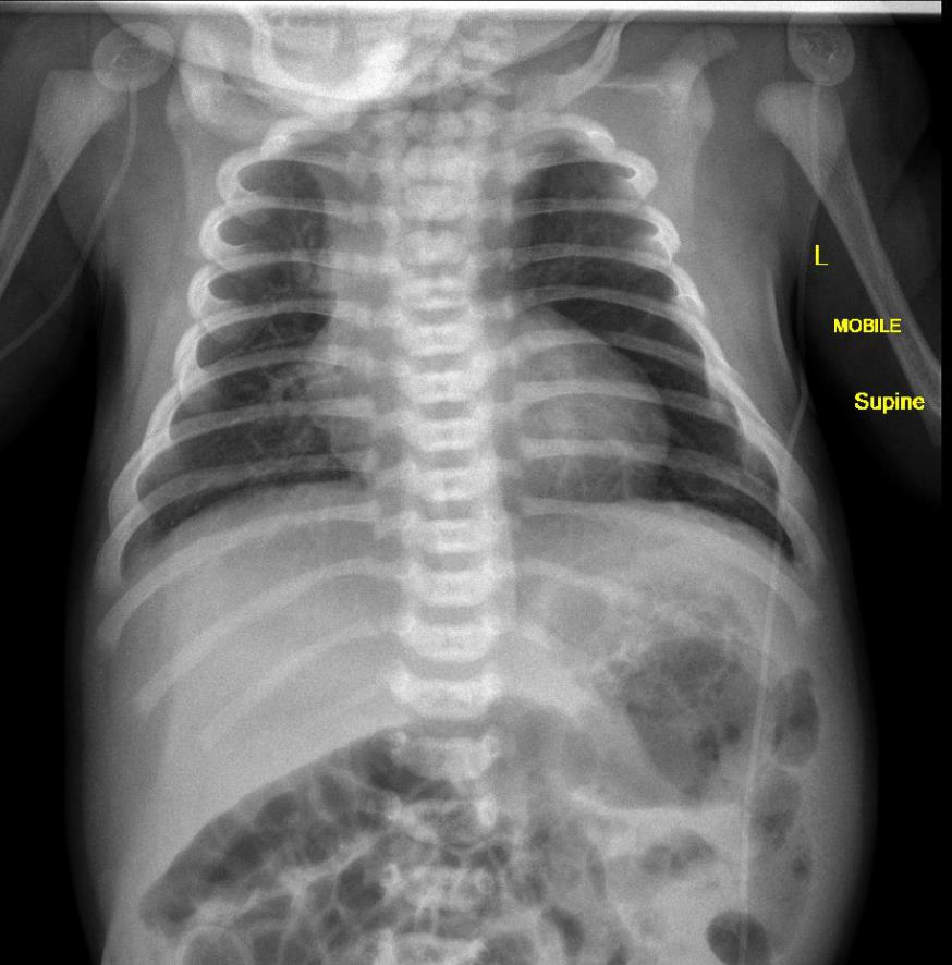 Transposition Of The Great Arteries X Ray