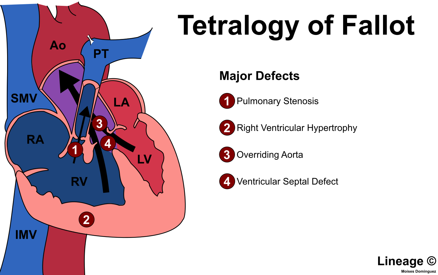 Tetralogy of Fallot - Cardiovascular - Medbullets Step 2/3