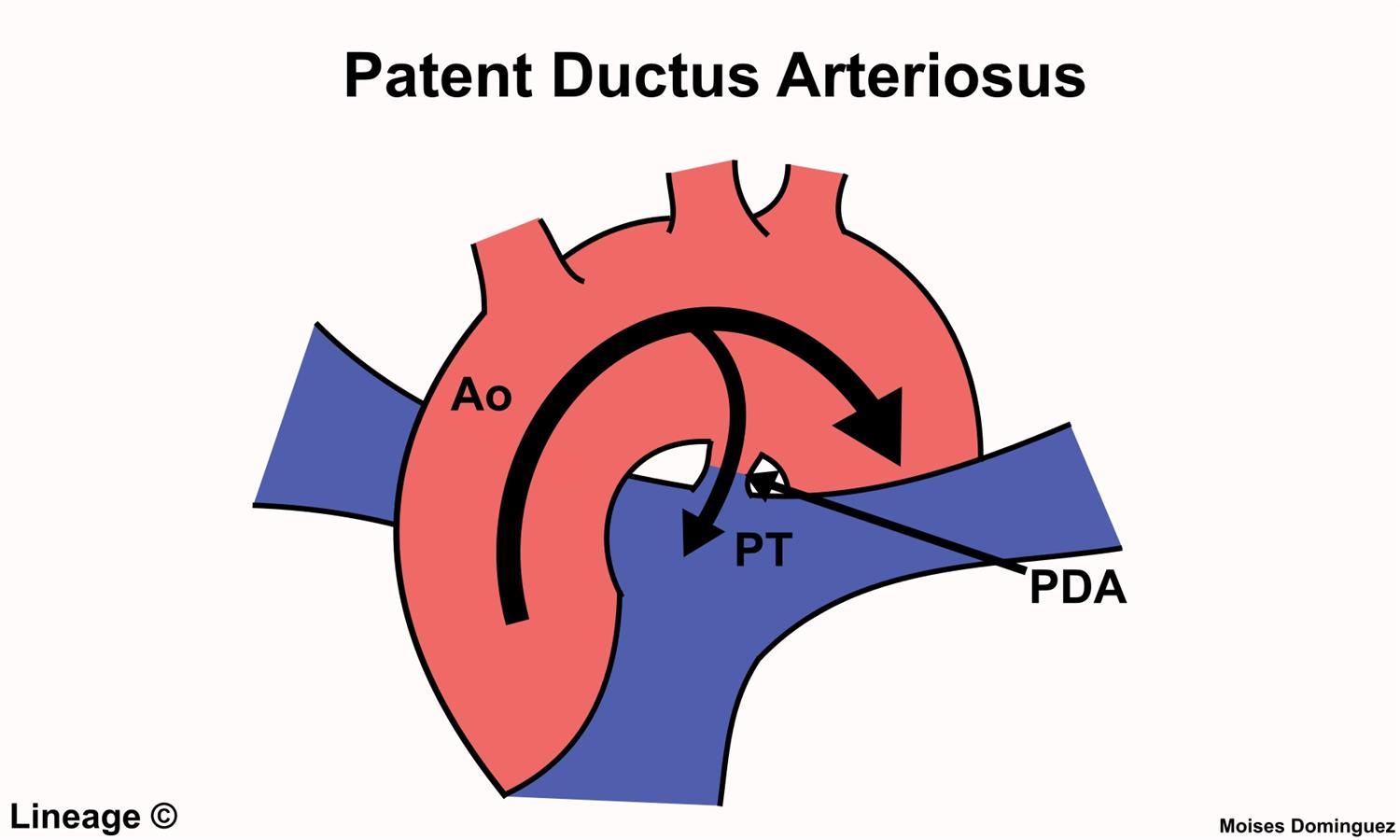 Patent Ductus Arteriosus Pathophysiology