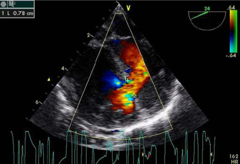 Ventricular Septal Defect (VSD) - Cardiovascular - Medbullets Step 2/3