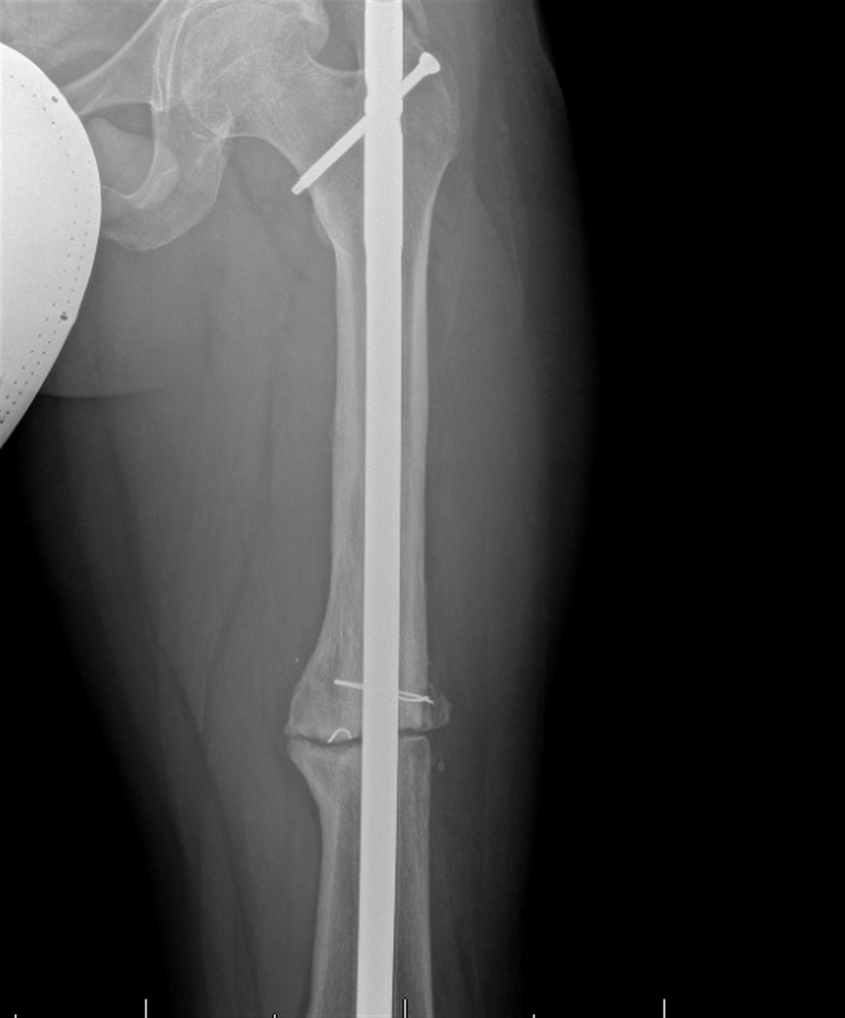 Intertrochanteric fracture femur - meryex