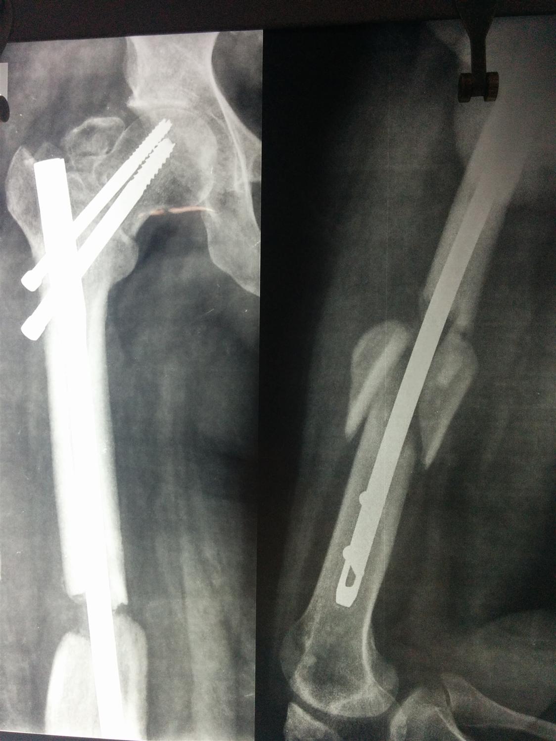 Femoral Shaft Fractures - Trauma - Orthobullets.com