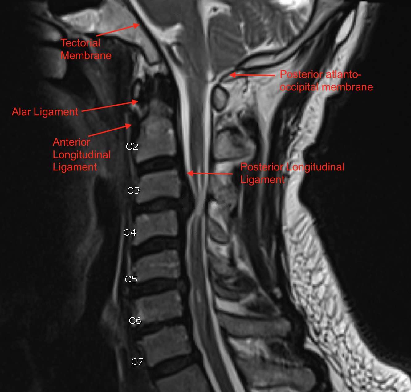 Cervical Spine Mri Labeled