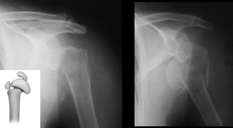 Proximal Humerus Fractures - Trauma - Orthobullets