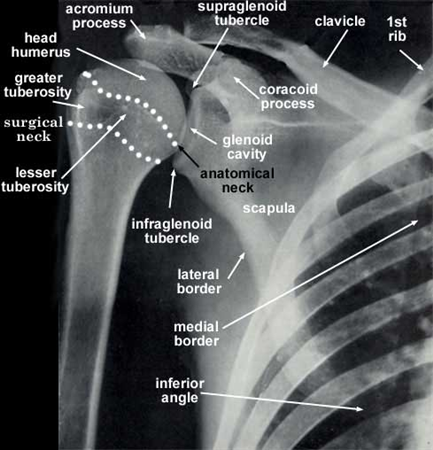 Proximal Humerus Fractures Trauma Orthobullets Images