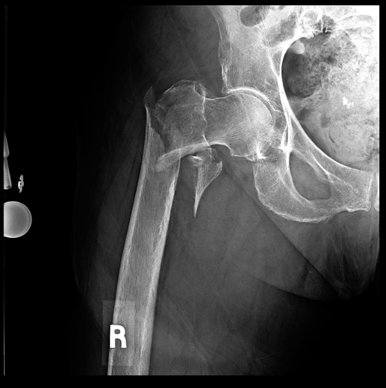 Normal hip xray femoral neck fracture xray - srtere