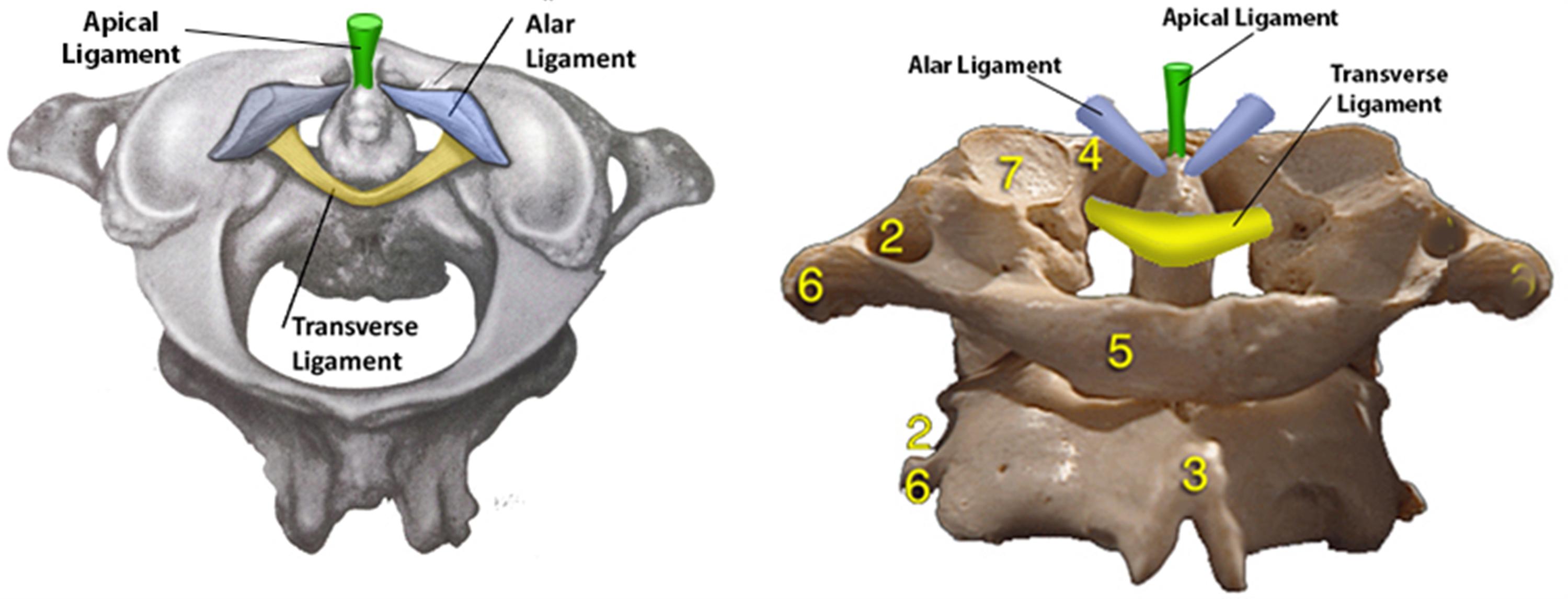 Occipital Condyle Fracture Treatment