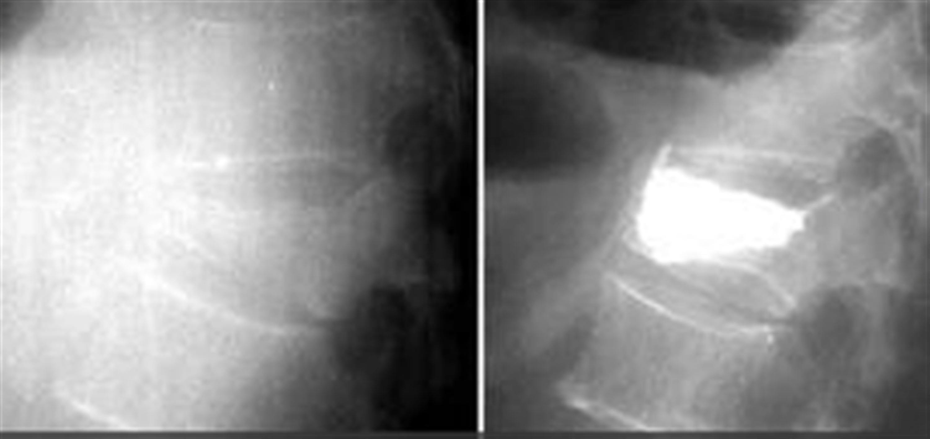 Compression Fracture Lumbar