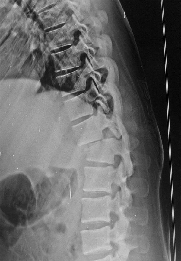 Lumbar Fracture Types