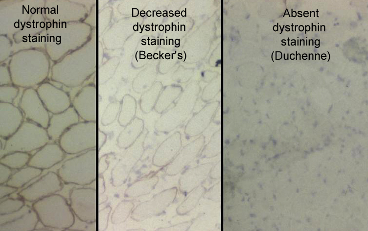 Duchenne Muscular Dystrophy - Pediatrics - Orthobullets