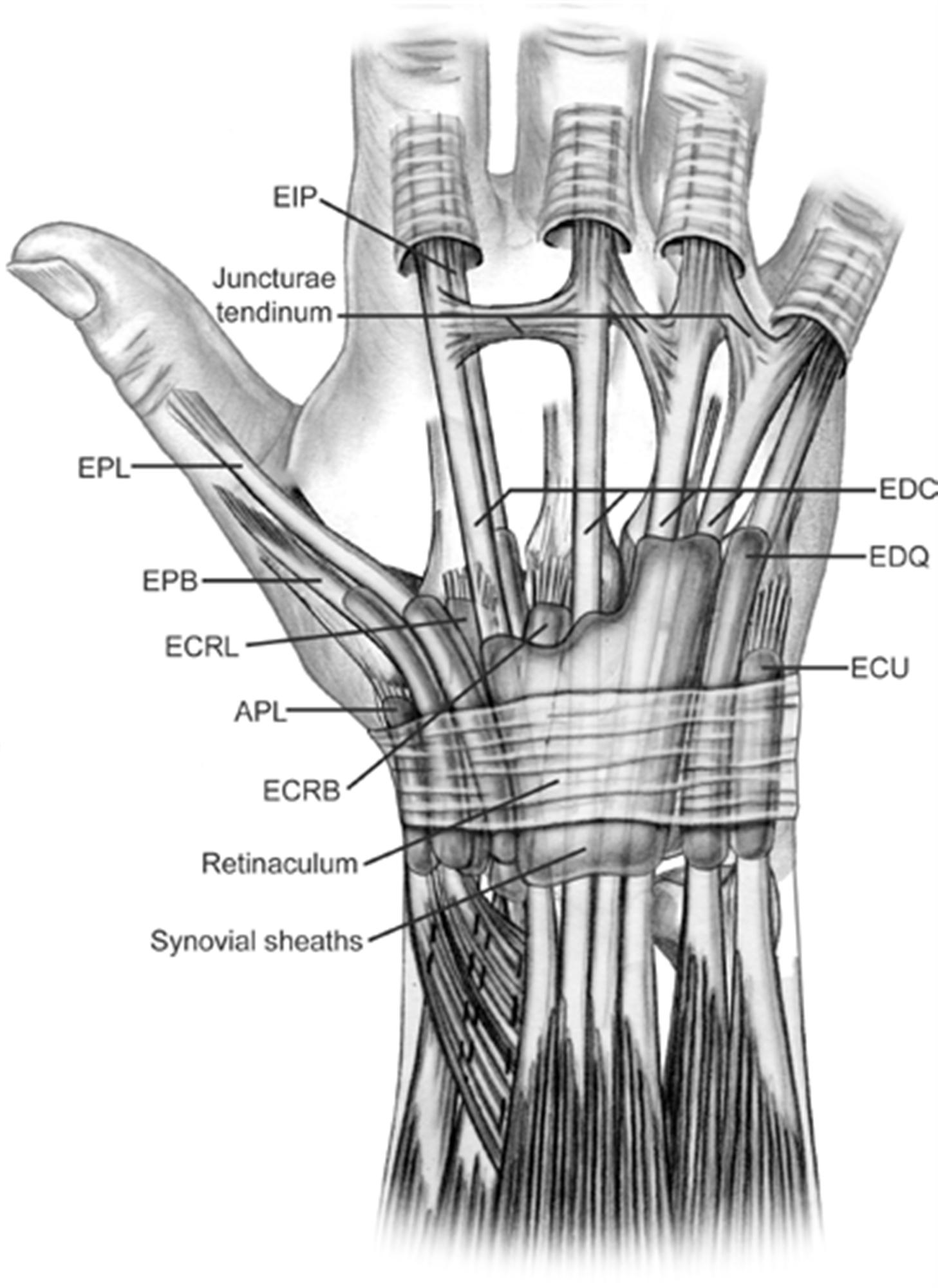 Sagittal Band Rupture Splint