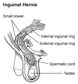 Hernia