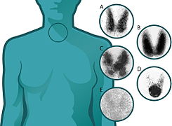 August 17: 5 different scintigrams taken from thyroids with different syndromes