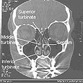 Front cross CT sections of nasal cavities in a normal nose