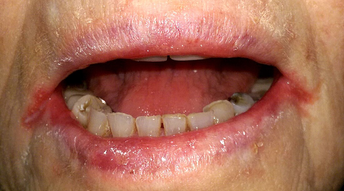 Angular cheilitis