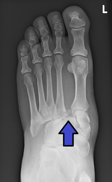 Lisfranc injury