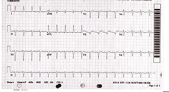 August 23: ECG from a patient with confirmed Takotsubo cardiomyopathy