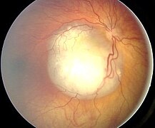 December 31: Ocular fundus aspect of retinoblastoma