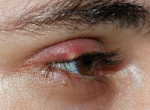 Picture of a stye on an eye lid