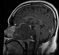 March 4: MRI scan of a chordoma.