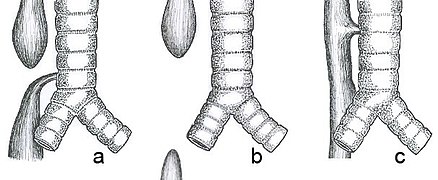 September 6: Common anatomical types of esophageal atresia