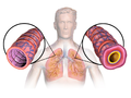 Thumbnail for File:Asthma (Lungs).png