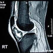 October 3: MRI scan of an osteochondroma.