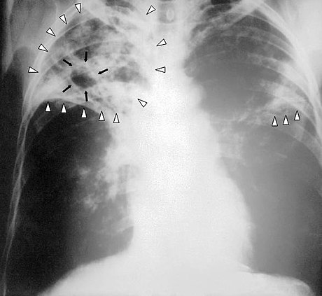 Tuberculose