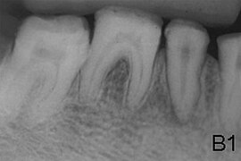 March 2: Amelogenesis imperfecta.