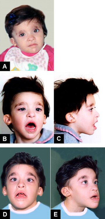 Mowat–Wilson syndrome