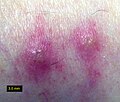 Chigger bites on human ankle skin; Alabama.