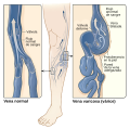 español varicose veins