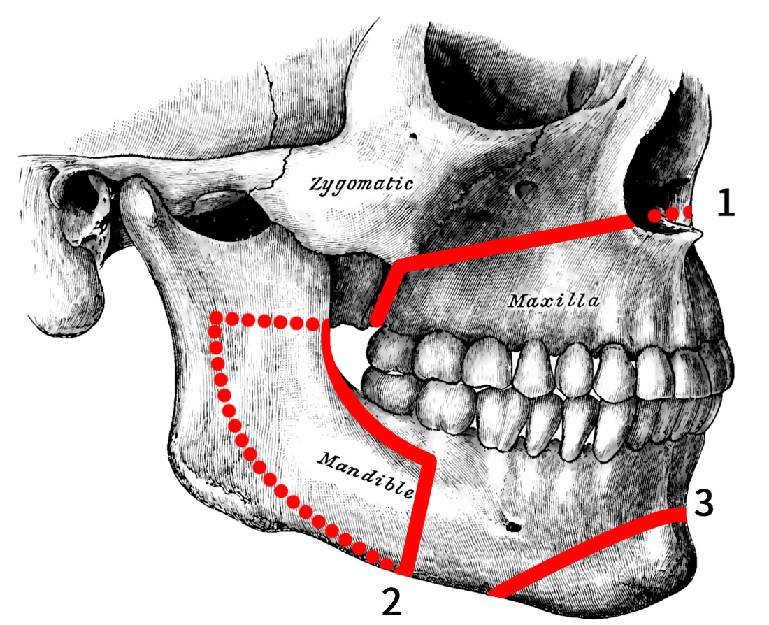 Orthognathic surgery