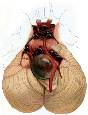 Intracranial aneurysm