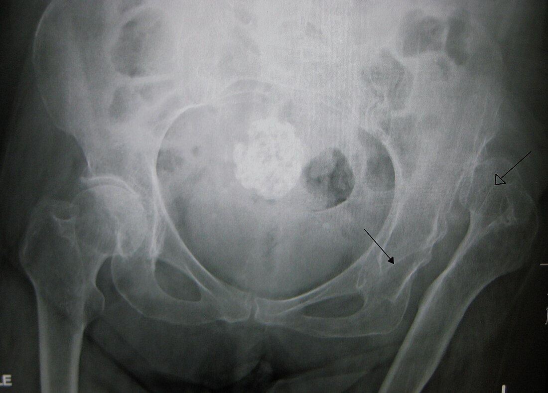 Hip dysplasia