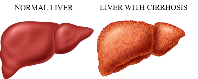 Child Pugh Calculator - Cirrhosis of the Liver