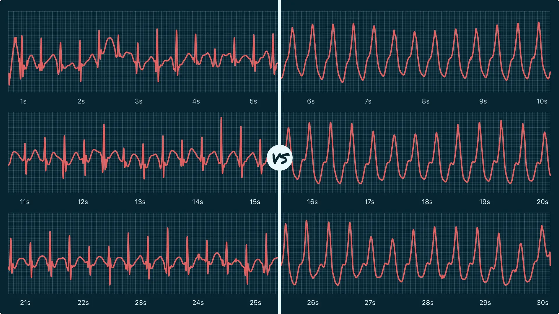 Supraventricular Tachycardia (Sustained) Vs. Ventricular Tachycardia ...