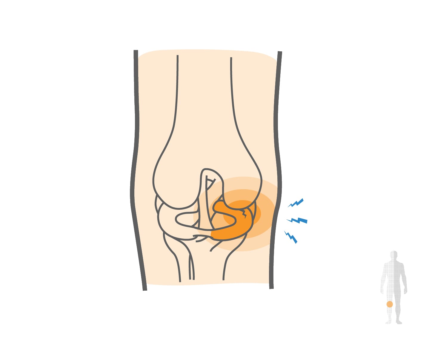 Medial Meniscus Tears Hero Image 2