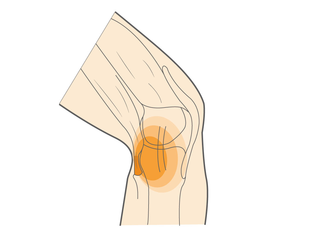 Hamstring Tendonitis of the Knee Hero Image 2