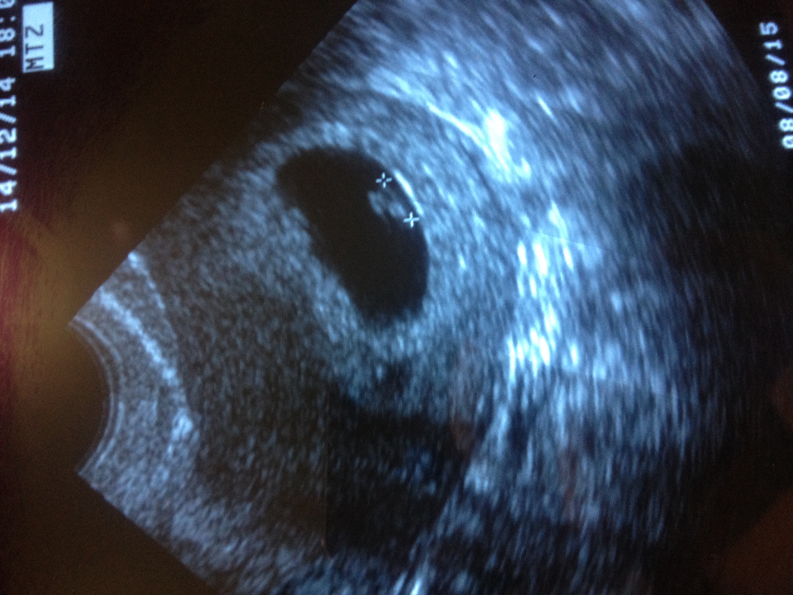 Ultrasound Pics and Chatter - Page 2 — The Bump